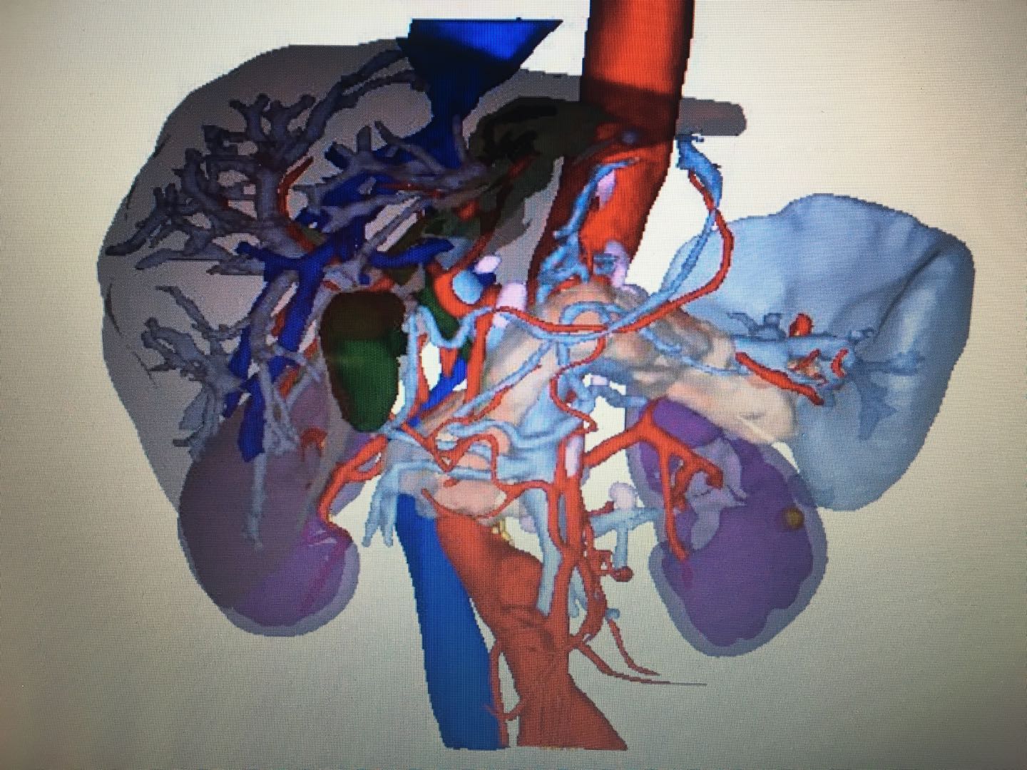 肝内胆管结石微创治疗方式,治疗肝内胆管结石有特效药吗