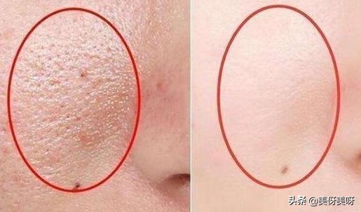 人为什么会长黑头求解：黑头白头的成因及结构和去除方法