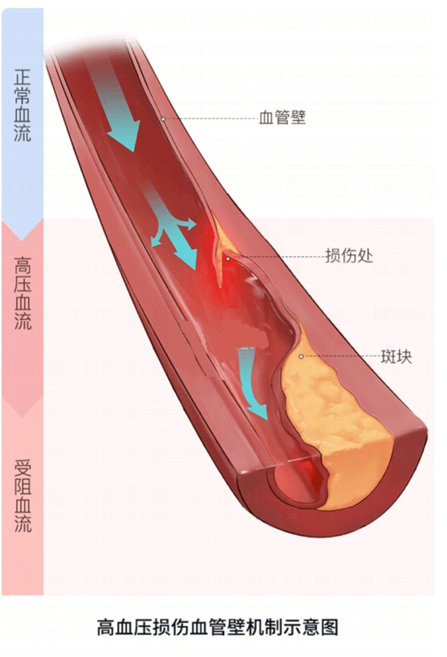 高血压高血脂适合打新冠疫苗吗,高血压疫苗打了要不要吃降压药