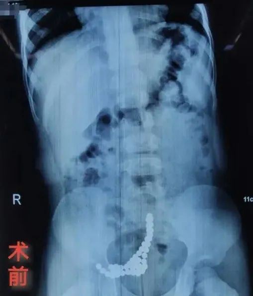 一岁男童突发肠穿孔,男童肠道穿孔是什么原因