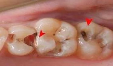 急性牙髓炎怎么应急,急性牙髓炎该怎么紧急处理