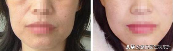 鼻唇沟泪沟法令纹,18岁有眼沟纹和法令纹怎么办