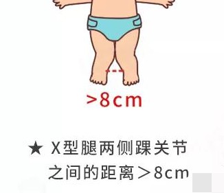 髋关节发育不对称怎么办,腿纹不对称髋关节发育不良