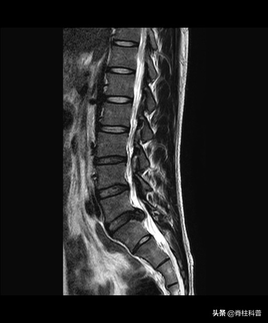 x光看不清楚ct显示骨折,x光看不出腰突吗