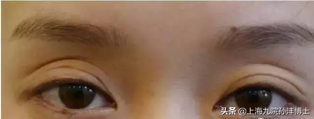 19岁全切双眼皮恢复图真实,眼修复手术