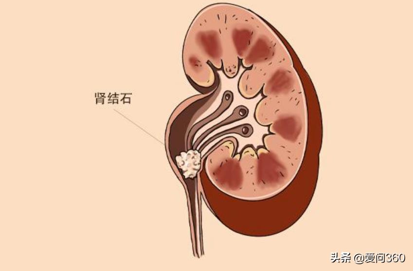 肾结石通常是什么原因造成的,肾结石是怎么形成的有什么方法