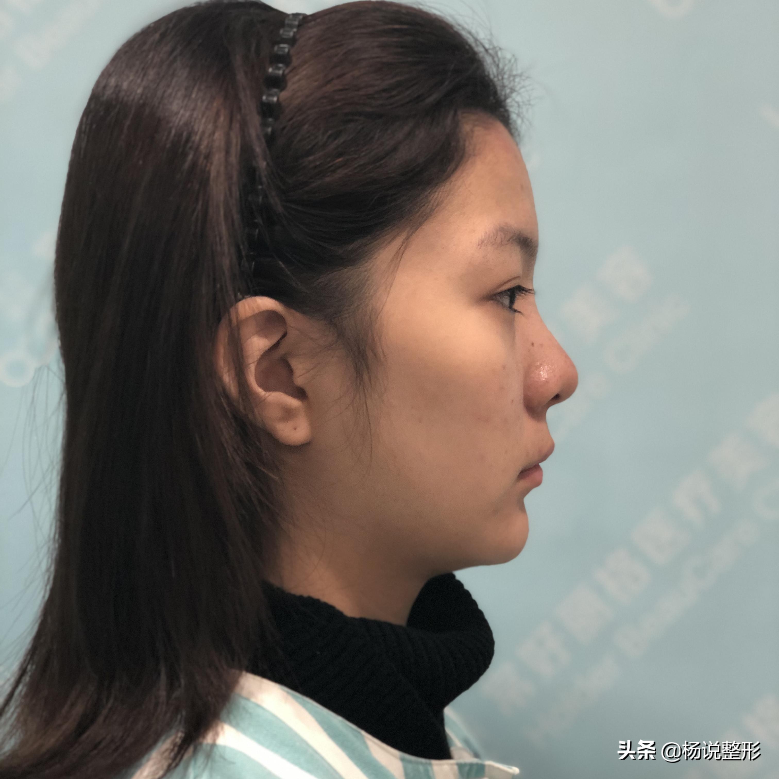28岁做线雕提升脸部好不好,28岁女人做线雕现状