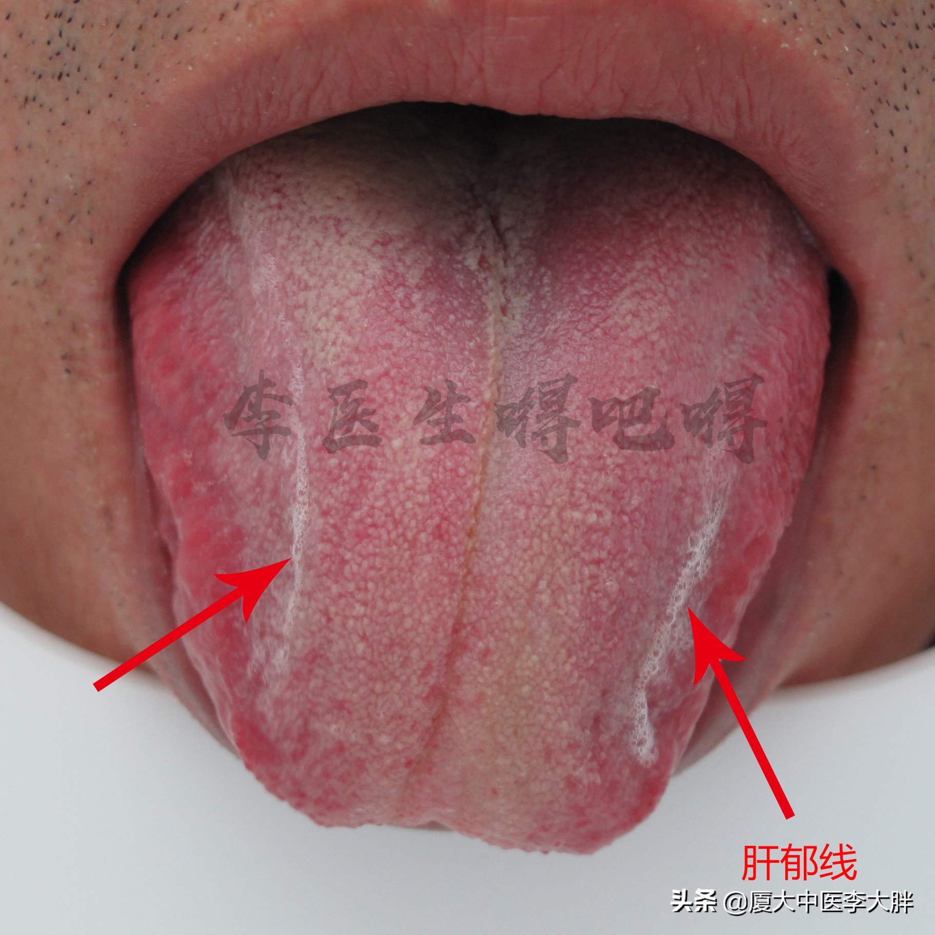 幽门螺旋杆菌哪些必须治疗,什么食疗方法治疗幽门螺旋杆菌