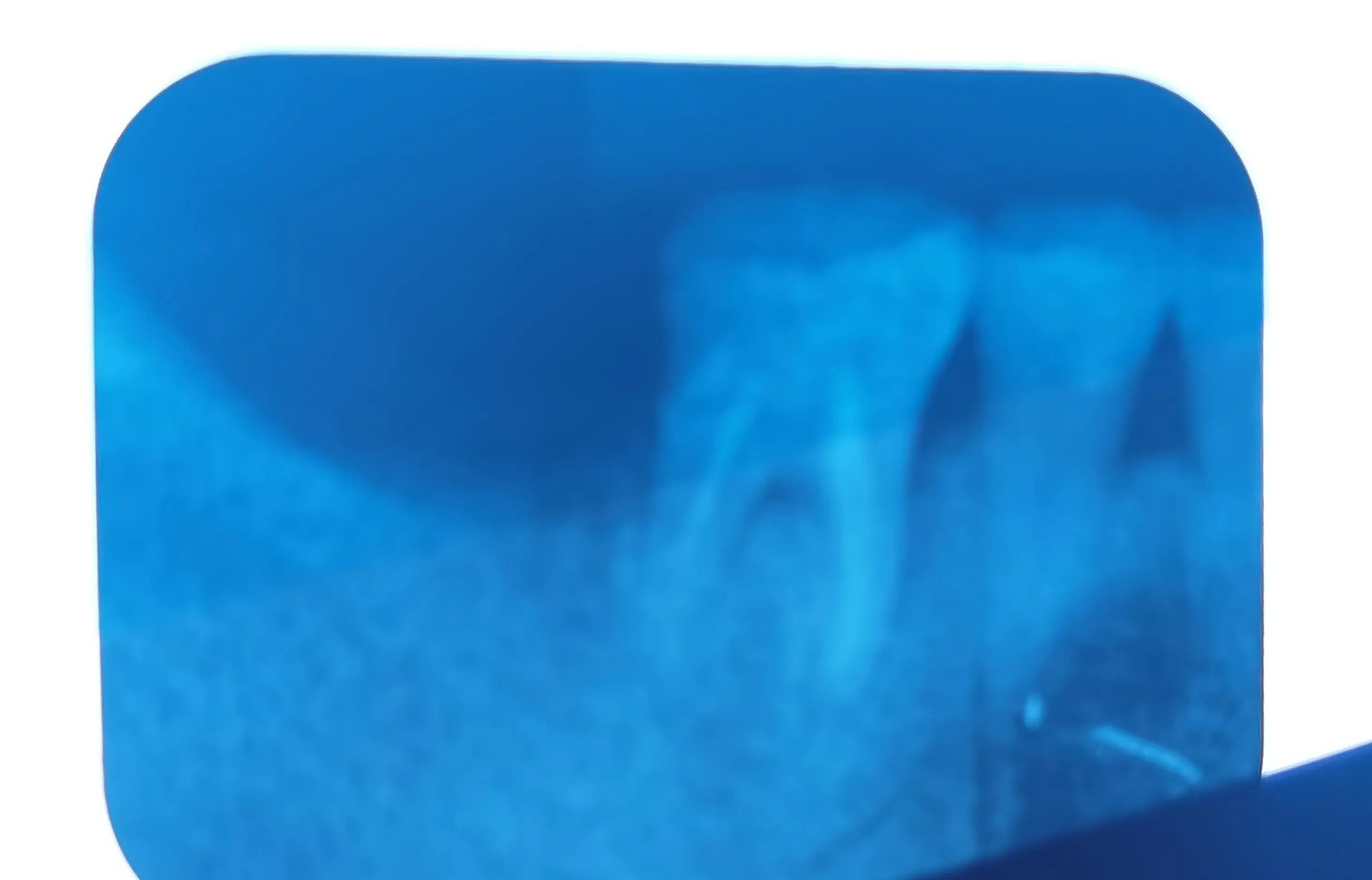 60后阿姨看牙经历：根管治疗后牙依然疼，持续一年不能用为什么？