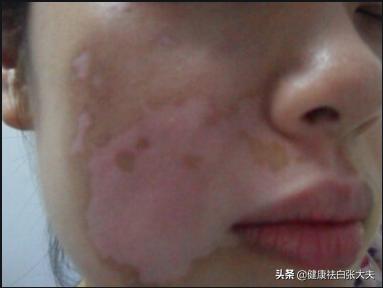 女性白癜风抹药后痒是怎么回事,白癜风处起红疹是怎么回事
