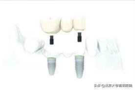 牙列缺损与牙体缺损,牙体缺失和牙列缺损区别