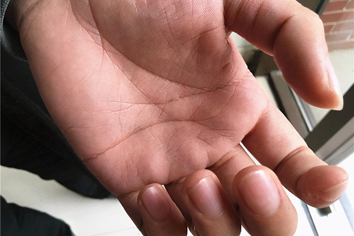 烫伤后皮肤是怎么恢复的,烫伤后皮肤是怎么修复的