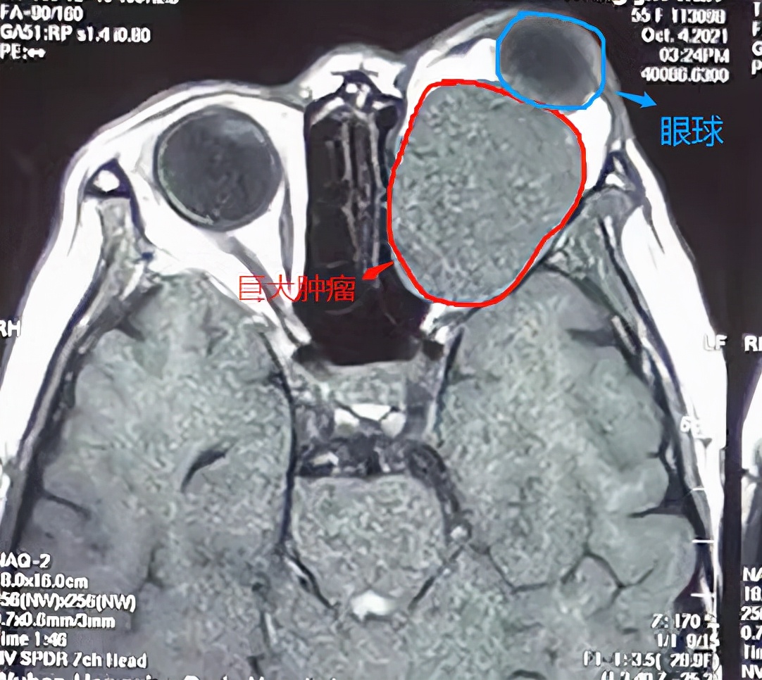 恶性肿瘤导致眼球外突,眼球中最可怕的肿瘤