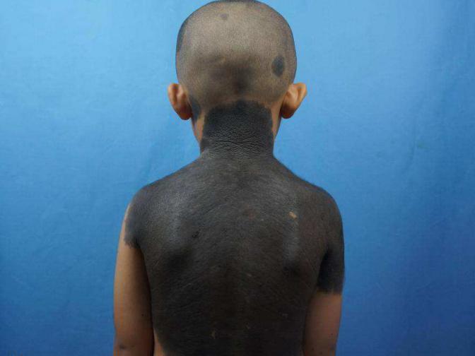 黑毛痣做了激光还会恶化吗,黑毛痣上毛发脱落一定是恶化吗