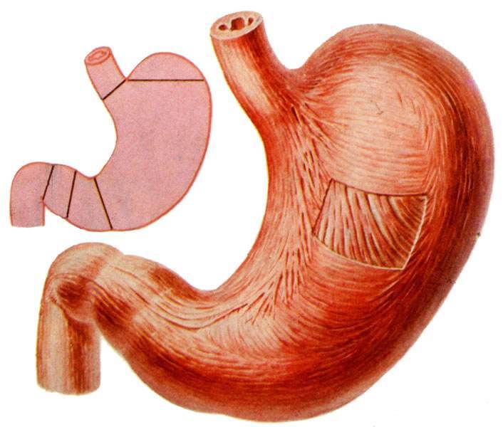 国家级名老中医治幽门螺旋杆菌,老中医治好幽门螺杆菌