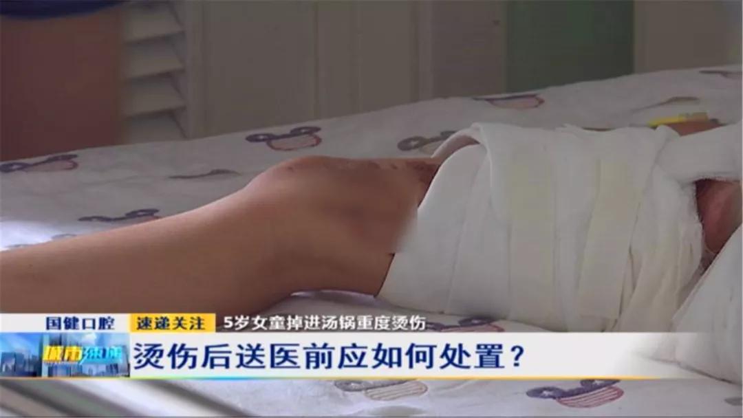 孩子被妈妈疏忽给烫伤,一岁女童掉进开水锅被烫伤