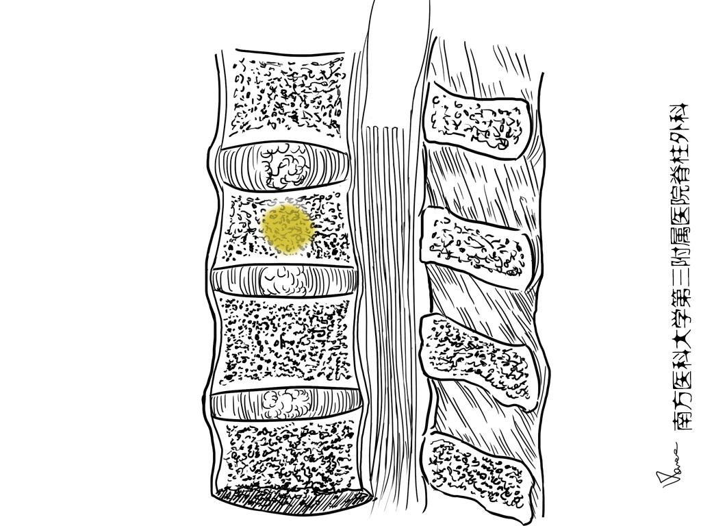 腰椎结核的抗结核药物疗法,脊柱结核的药物有哪些副作用