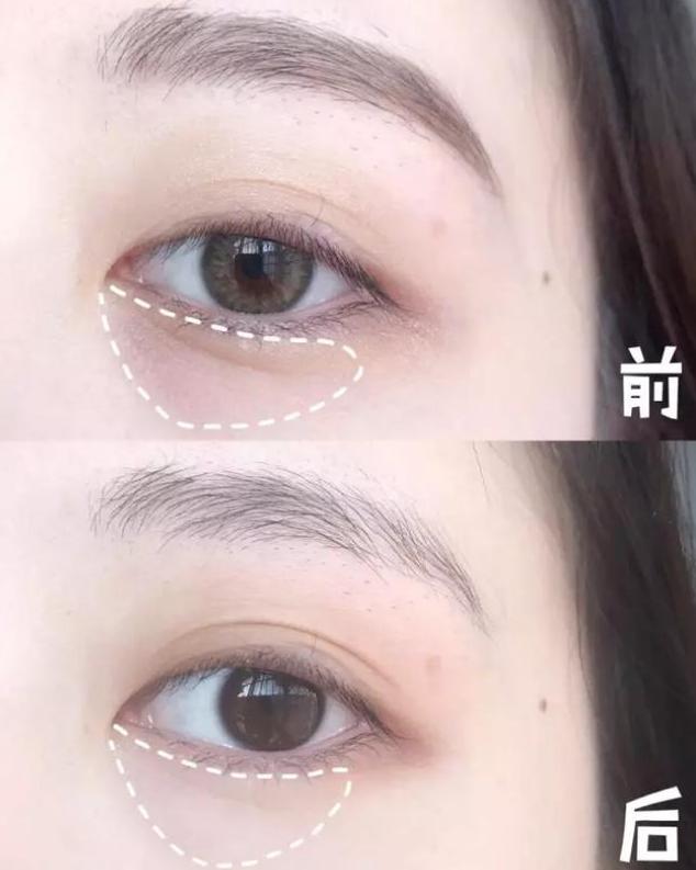 治眼袋皱纹最好的软膏,28岁的女生小细纹用什么抗衰祛皱