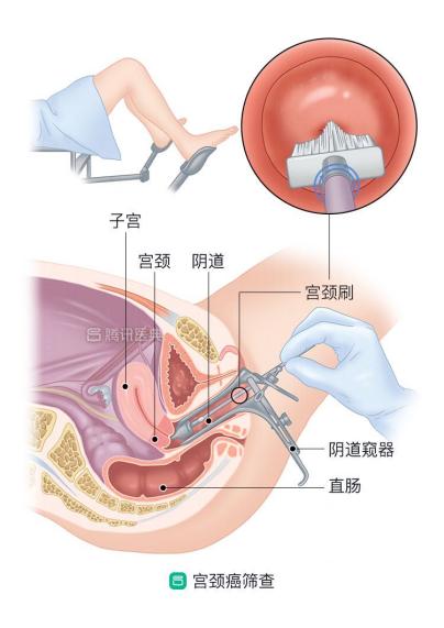 宫颈癌筛查与预防新进展,预防宫颈癌的运动