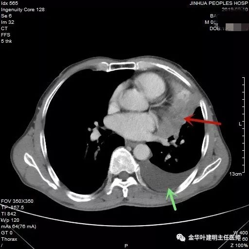 肺癌伴胸腔积液伴膨胀不全,肺癌晚期转移到肝脏引起腹腔积液