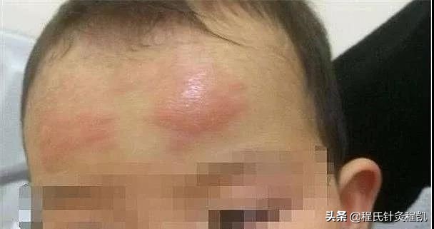 八个月宝宝发烧贴退热贴管用吗,小孩发烧退热贴真的有用吗