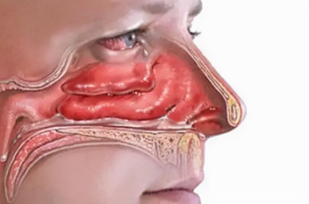 鼻炎为什么治不好,鼻炎到底该怎么治疗