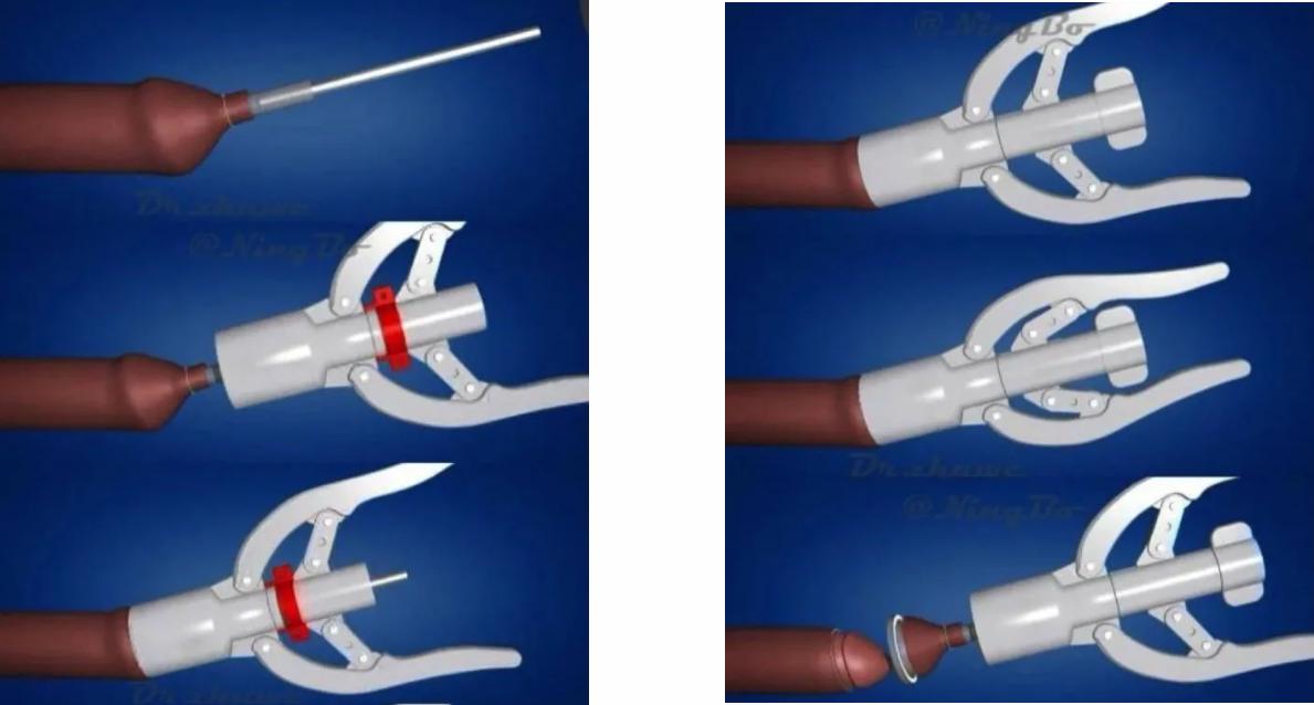 几岁可以做包皮切割手术,包皮切割手术什么年龄最适合