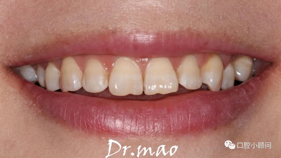 鎬庝箞缇庣櫧鐗欓娇,鐗欓娇璐寸墖缇庣櫧