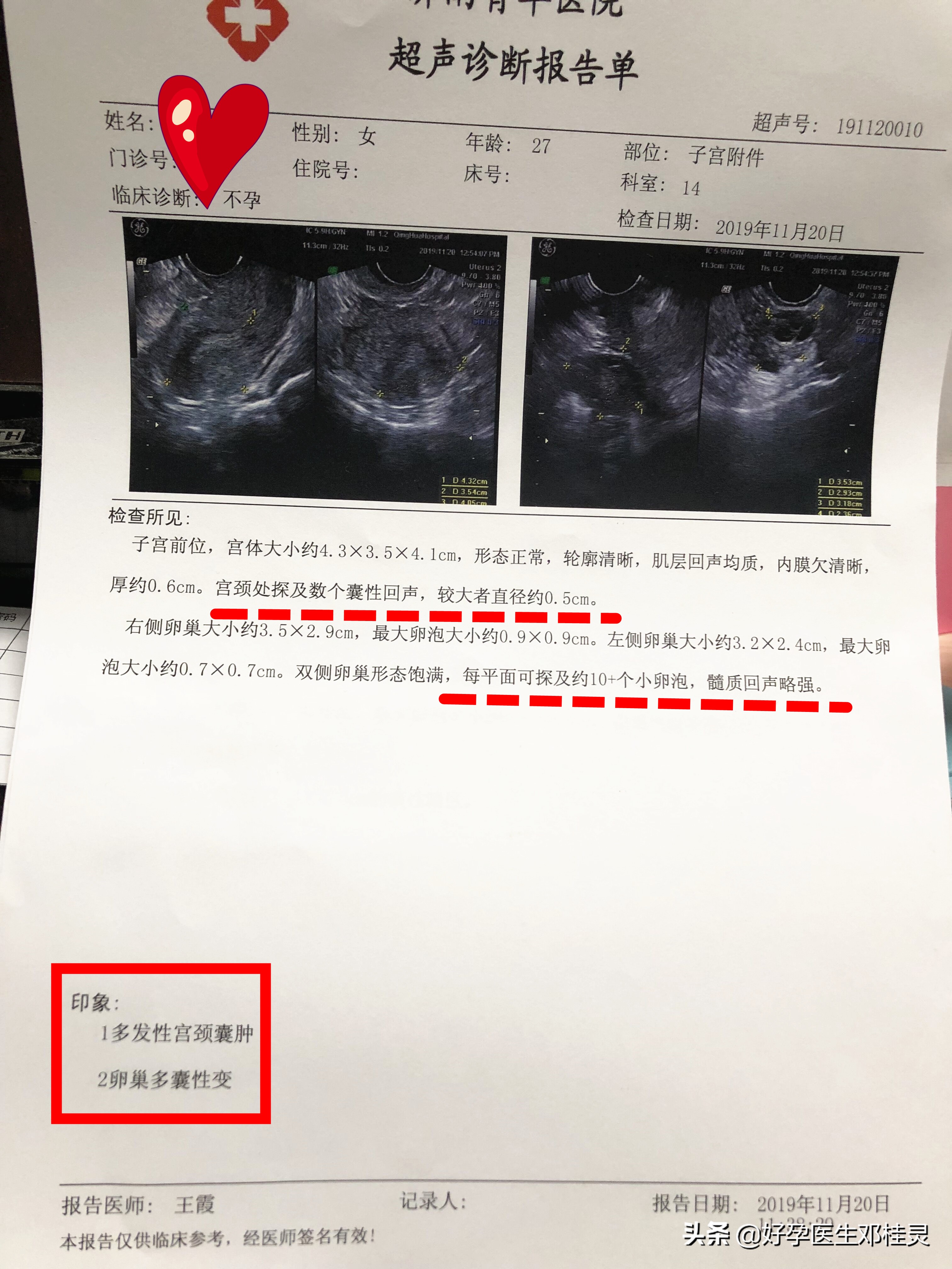 体检b超能查出来多囊卵巢,女性检查出来多囊