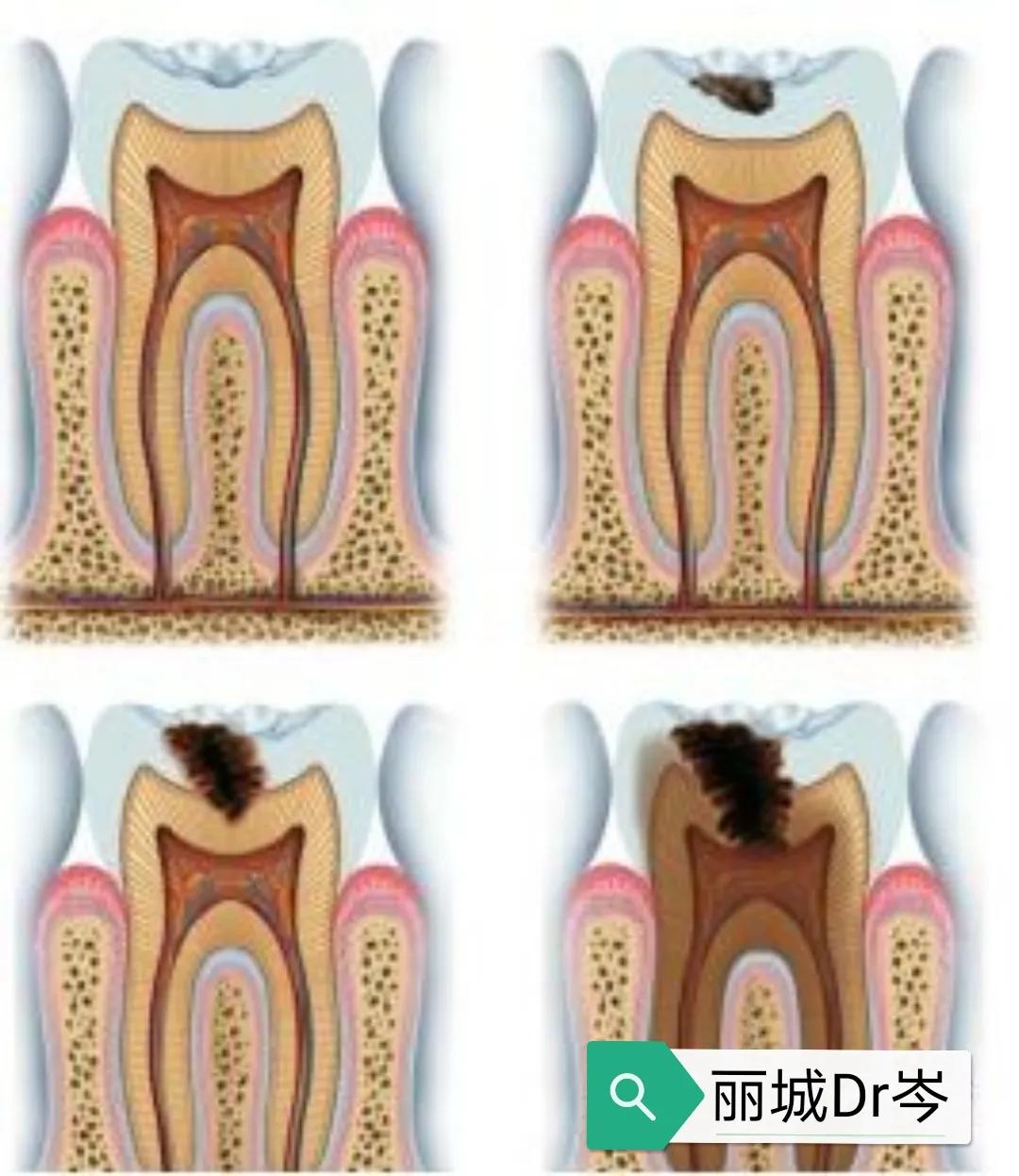 什么情况要做根管治疗,根管治疗是怎么样一个过程