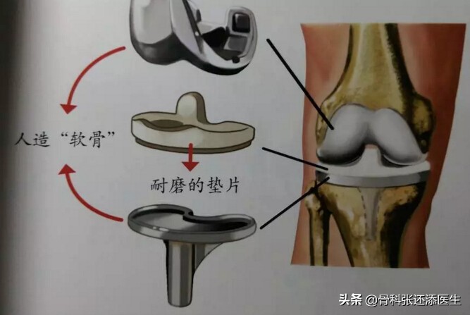 膝关节置换最坏后果,膝关节置换手术吓人