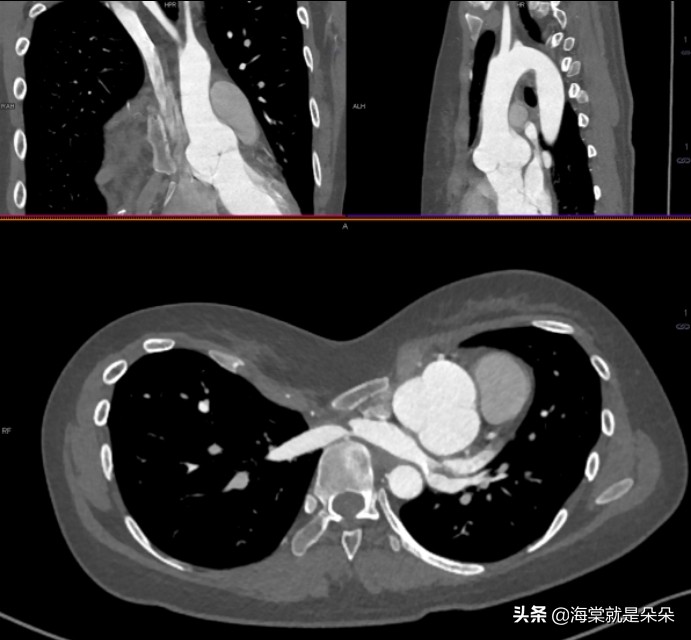 先天漏斗胸跟心脏不好有关吗,成年人漏斗胸压迫心脏
