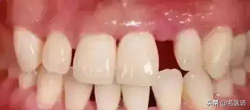 洗牙和牙周刮治区别在哪里,洗牙刚洗好隔天能做牙周刮治吗