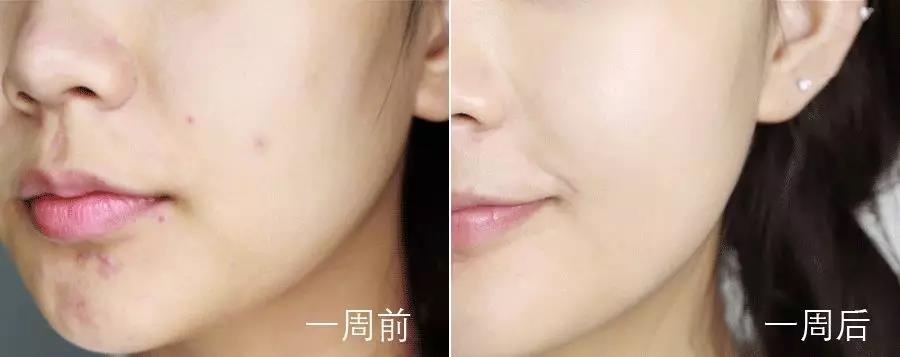 真实有效的几款祛痘印神器,祛痘印最有效的方法排名