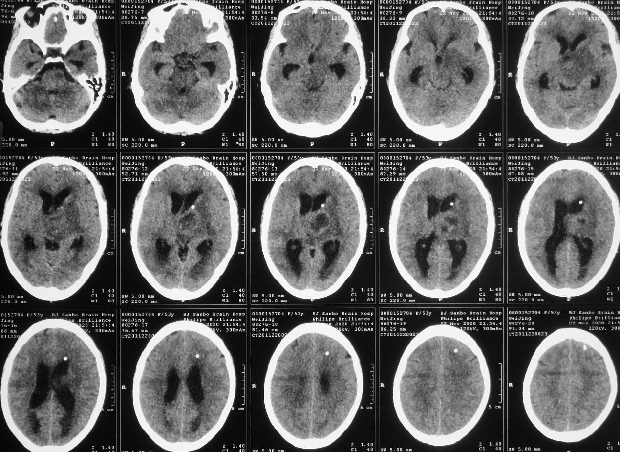 脑脓肿合并脑膜炎需要手术吗,脑脓肿进入左侧脑室严重吗