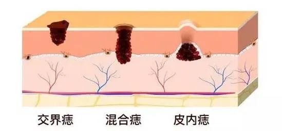 脸上点了痣能洗脸吗应注意什么,这四种痣一定要引起注意了