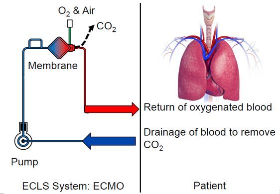 新冠肺炎用上ecmo有哪些要注意的,ecmo在新冠肺炎治疗中作用