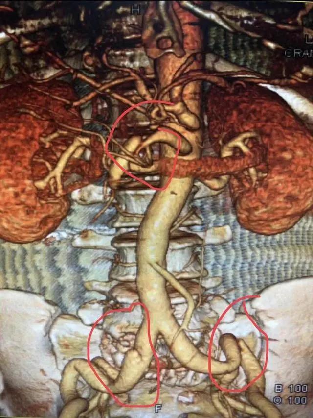 男子减肥一个月暴瘦60斤,男子减肥从200多斤减到100多斤