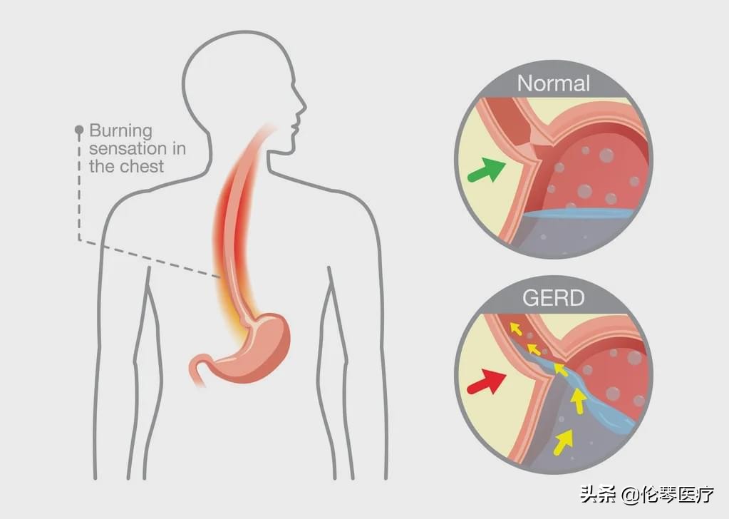 2022年恶性肿瘤筛查与预防指南,常见恶性肿瘤的预防和筛检