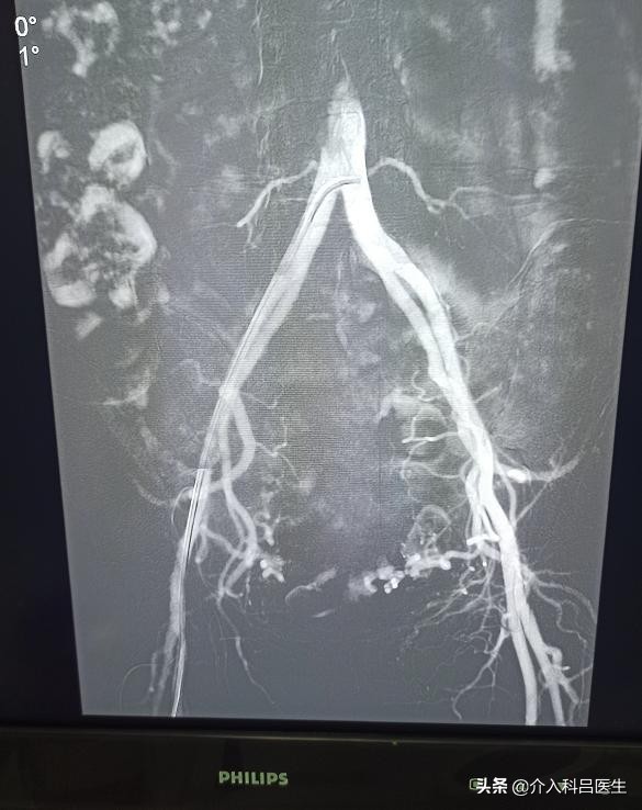 女性卵巢和子宫发育阶段,切除子宫和卵巢最好的方法