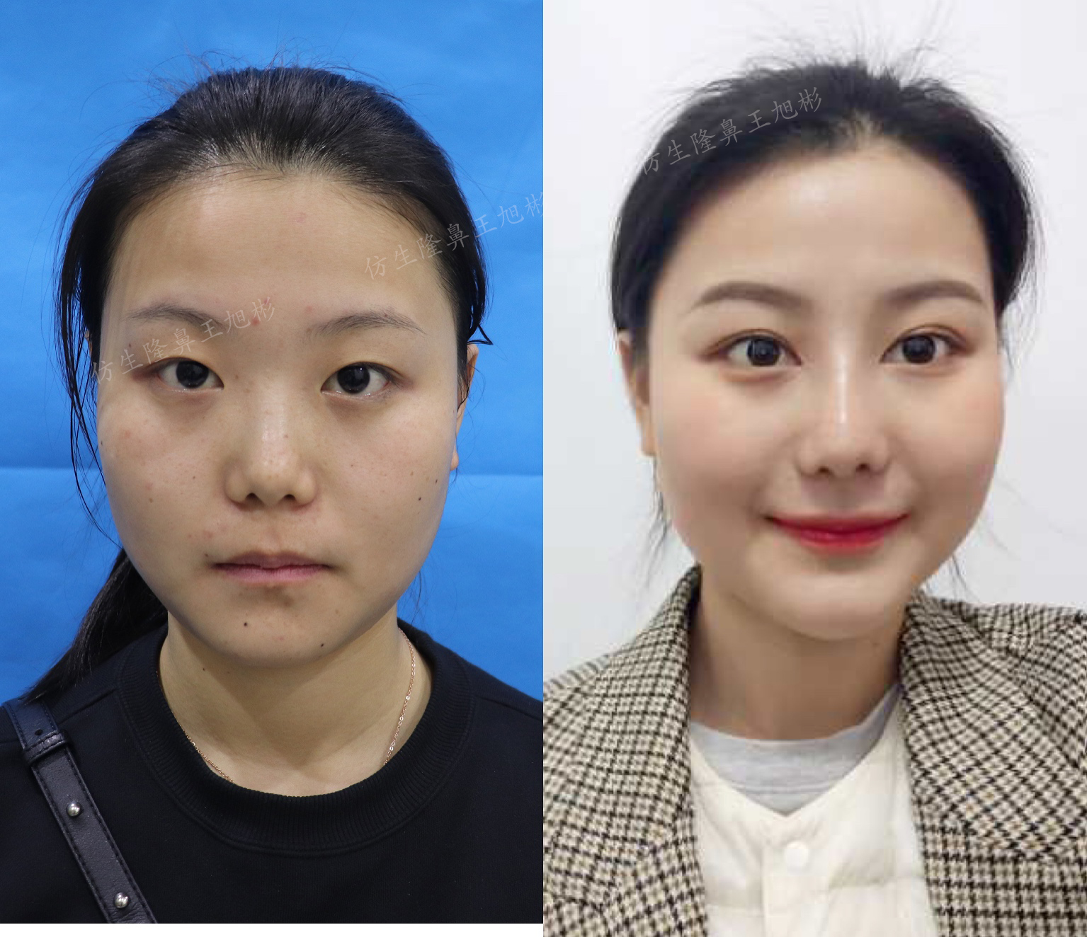 五官扁平的大饼脸,大饼脸和扁平五官怎样自救