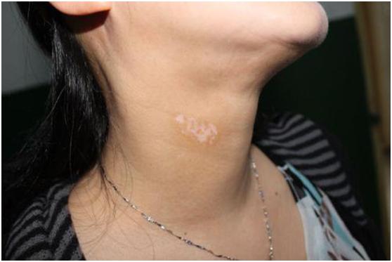 补骨脂治疗白癜风会好吗,补骨脂针剂治疗白癜风是天天打吗