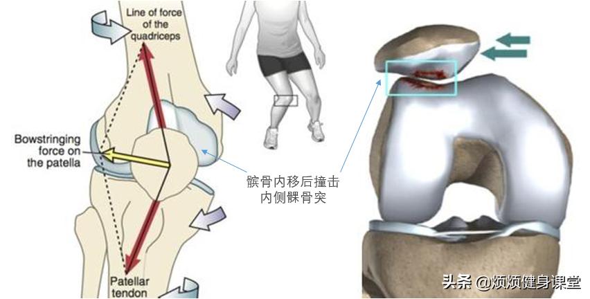 跑步膝盖内扣几个动作解决,膝盖内扣训练方法大全集