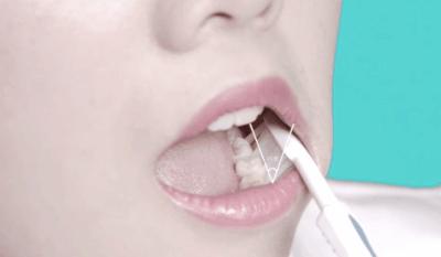 2岁半宝宝牙坏了需要补吗,宝宝乳牙大部分坏了会影响换牙吗