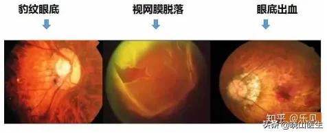 豹纹状眼底是什么原因引起的,近视眼都有豹纹状眼底吗