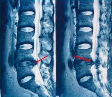 预防腰突锻炼法,防治腰突的特效药