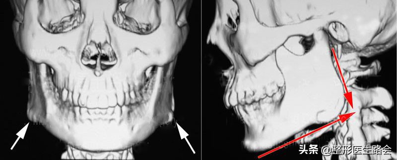 下颌角是天生的还是会给咬肌撑大,为什么脸大但是下颚线明显
