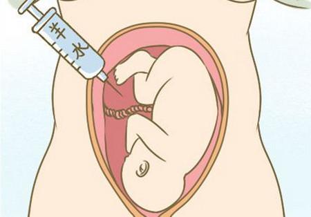 妇产科医生:什么是羊水穿刺?哪些孕妈妈需要做这个检查?