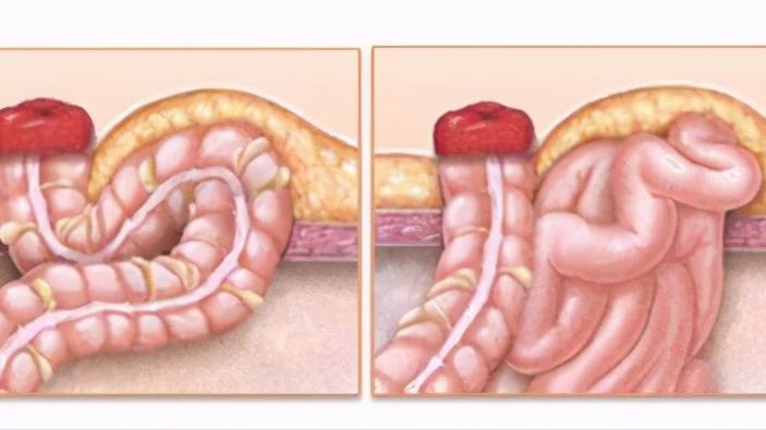 直肠癌患者，如果做了临时回肠造口，需要注意哪些事项？