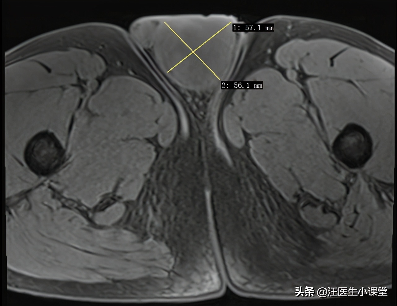 男的睾丸旁边有小肿瘤是什么原因,男性睾丸有小疙瘩越来越大